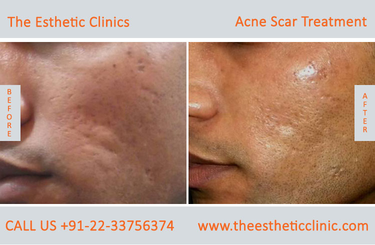 face acne scars removal laser treatment before after photos in mumbai india (4)
